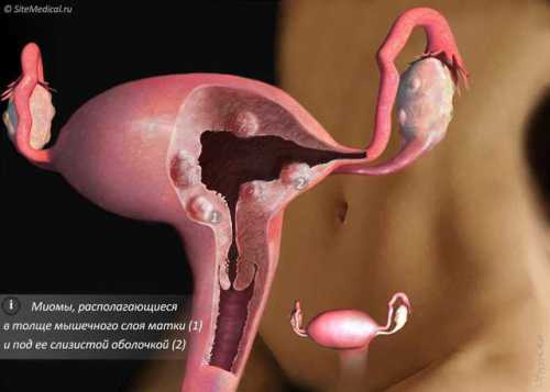 Фибромиома матки: беременность как способ профилактики и лечения