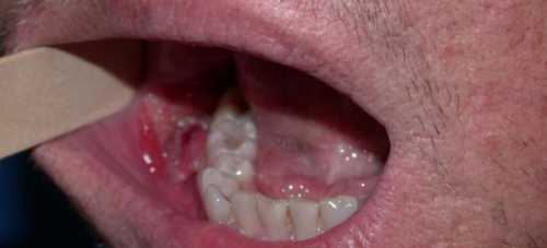 Появляются они в результате вскрытия десны или после устранения нервов внутри зуба