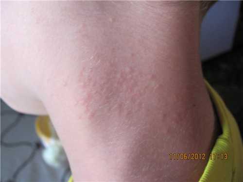Аллергия на клубнику: симптомы и лечение