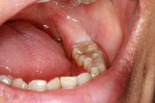 Воспаление после удаления зуба:  симптомы,