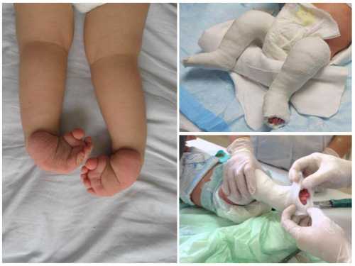 Так как врожденное косолапие у детей проявляется чаще, чем приобретенное, обследовать малыша нужно с первых дней жизни