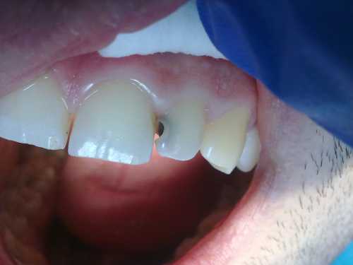 Болезнь может развиваться на любой поверхности зуба на коронковой части, из фиссур и борозд, у пришеечной части, в межзубных промежутках