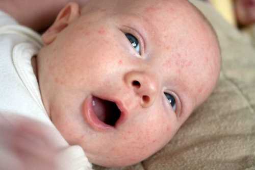 Эритема новорожденных: симптомы, причины, это