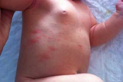 Причины, по которым возникает токсическая эритема у новорождённых